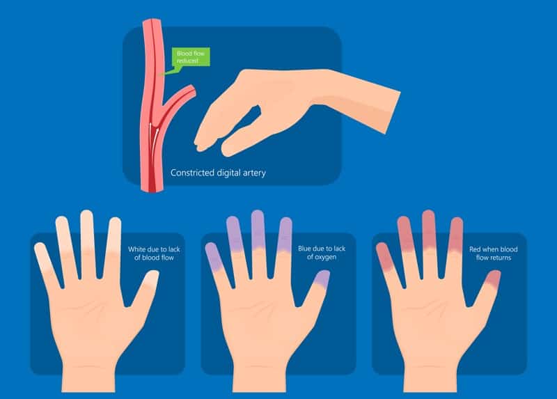 stadier kalla händer symptom på Raynaud