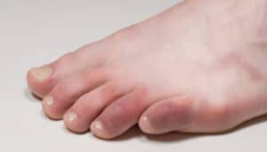 chilblains